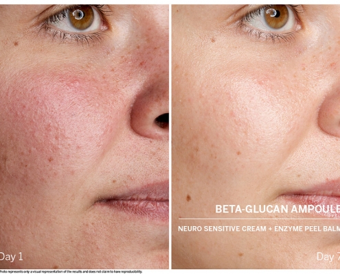 Beta-Glucan gegen Hautrötungen